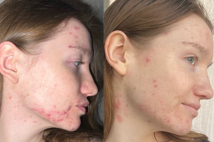 DIM Acne Skin Support