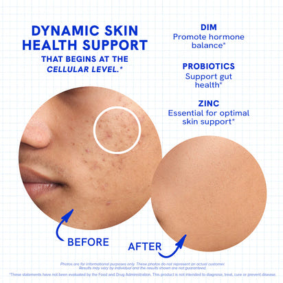 DIM Acne Skin Support