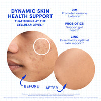 DIM Acne Skin Support